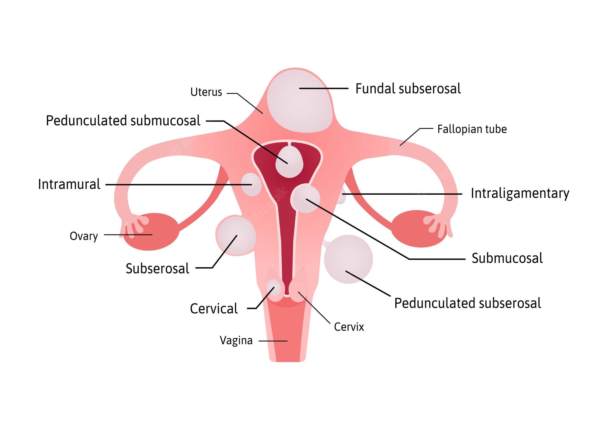 Fibroids Treatment